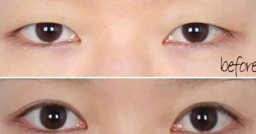 眼部整形能改善哪些症状